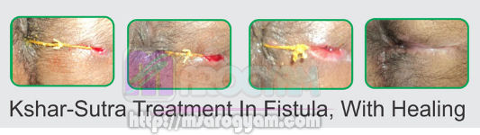 fistula treatment ksharsutra