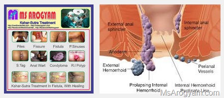 Home remedies for Hemorrhoids or piles 4